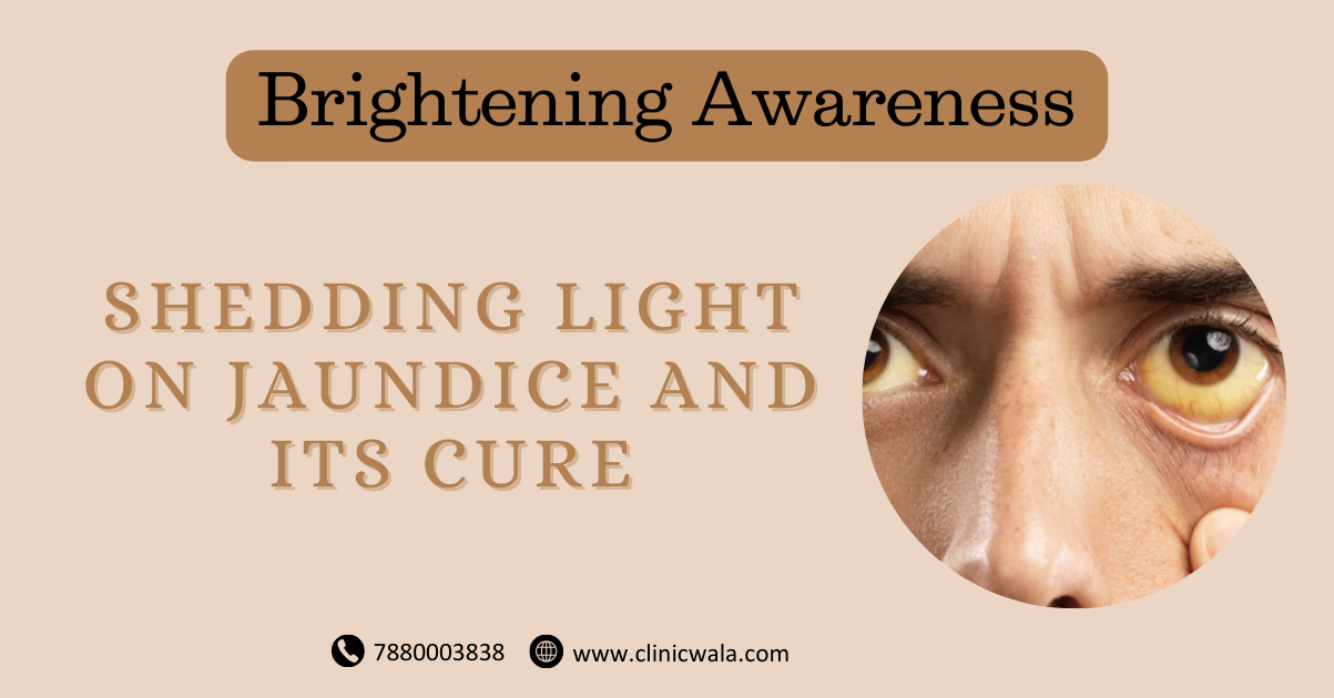 Be Aware of Jaundice! And Know The Symptoms, Causes and Treatment