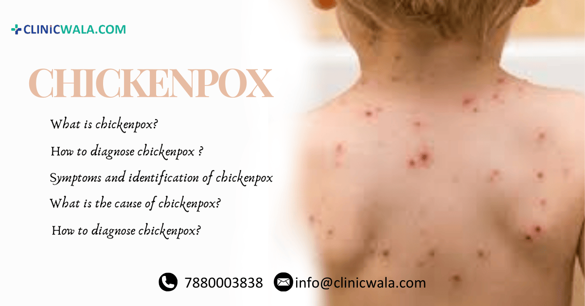 Chickenpox: Know all these things otherwise you can also get sick!