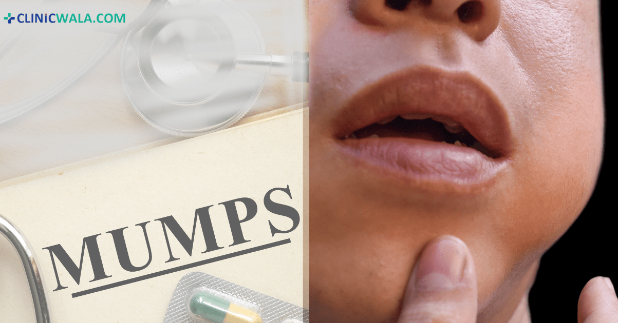 What are mumps? Know the causes, symptoms, and treatment!